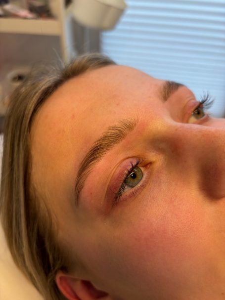 Brow Lifting
