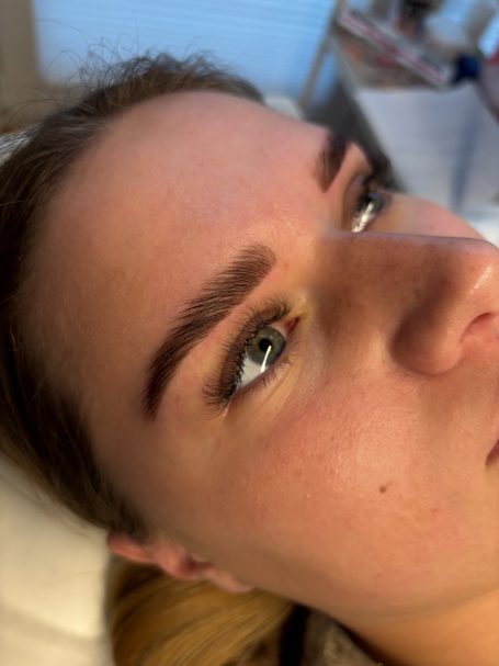 Brow Lifting